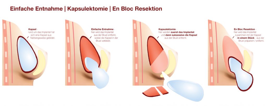 En Bloc Resektion Brustimplantate entfernen ... von Dr. med. Christina Günter München