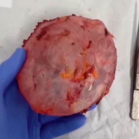 En Bloc Resektion Brustimplantate von Dr. med. Christina Günter München