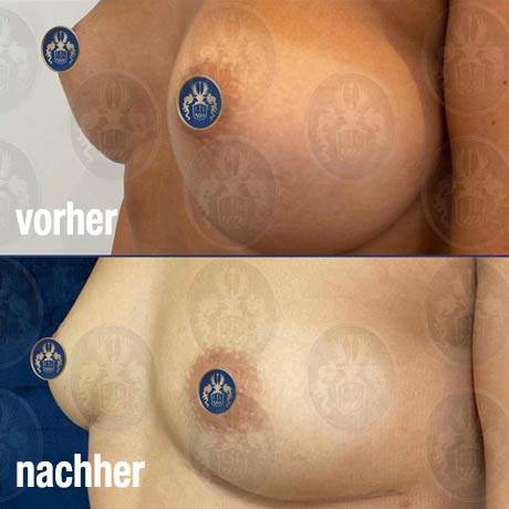 Brustimplanate entfernen - Dr. med. Christina Günter München